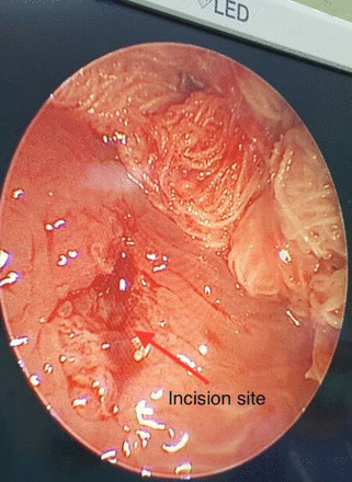 BELL THREADED INSERTS (BOTS)