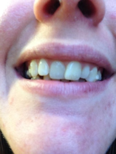 [CAT 1091634 BOTS] CAT SINGLE BOTTOM CLIP (BOTS)